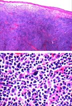 Microscopy -  Malignant lymphoma B-cell, T-cell rich cell type.